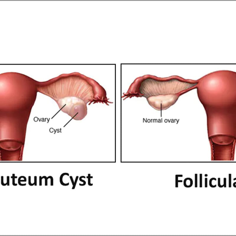 OVACIST DROPS-Freedom from PCOD,PCOS