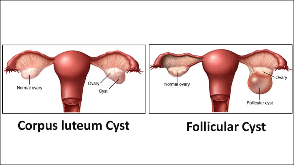 OVACIST DROPS-Freedom from PCOD,PCOS