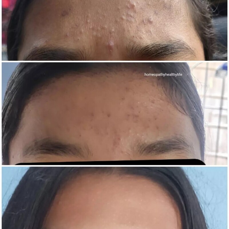Say Goodbye to Pimples with LDD Bioscience LD 43 Acne Drop: Your Ultimate Solution