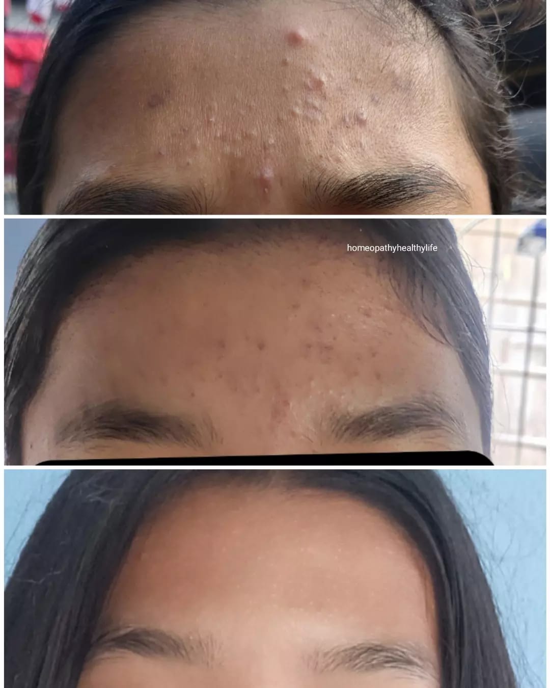 Say Goodbye to Pimples with LDD Bioscience LD 43 Acne Drop: Your Ultimate Solution